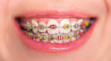 All About Braces: A Simple Complete Guide to Braces in the .